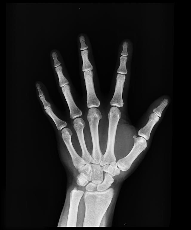 Illinois scoliosis Disability Attorney